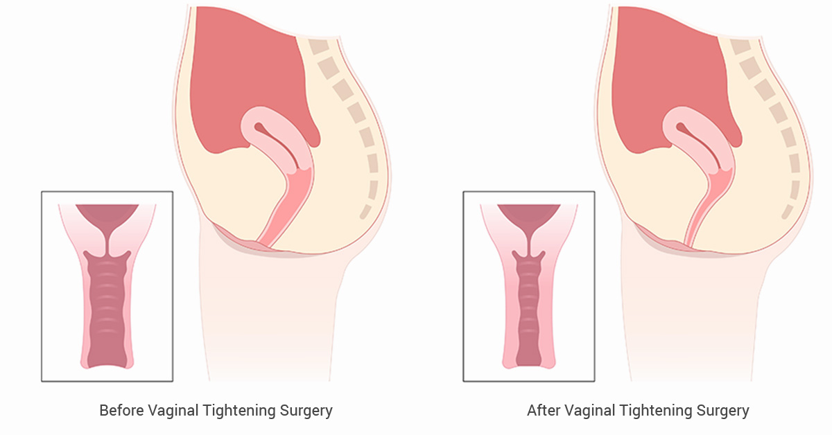 Vaginal Tightening Surgery & Orgasms in NYC