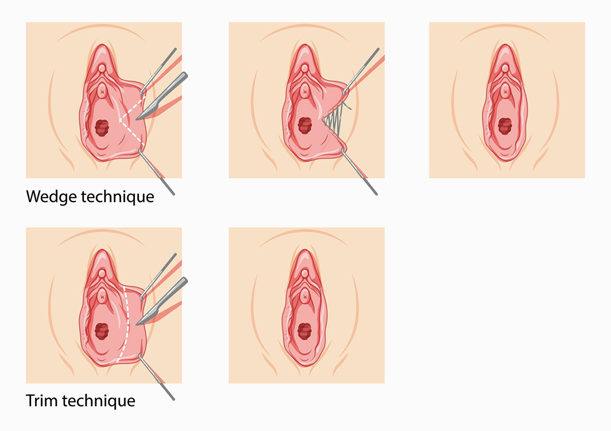 Tipos de Labioplastia en NYC