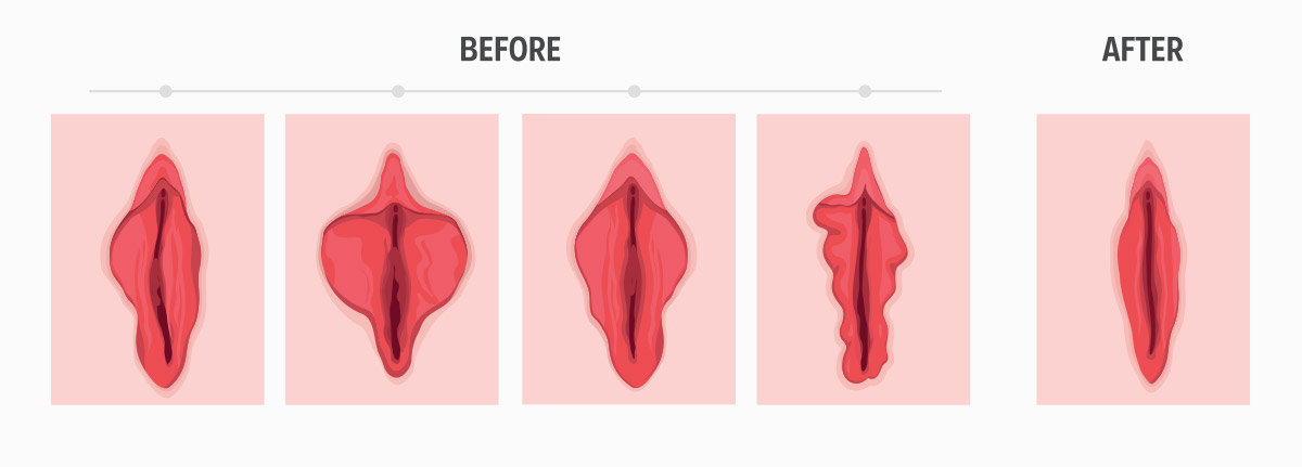 Understanding The Labial Anatomy in NYC