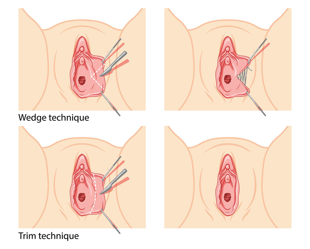 ¿Cuál es la finalidad de una labioplastia?