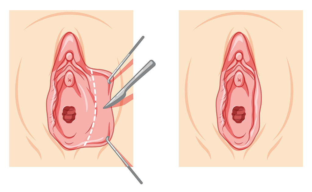 Soluciones eficaces para eliminar la piel sobrante de los labios vaginales