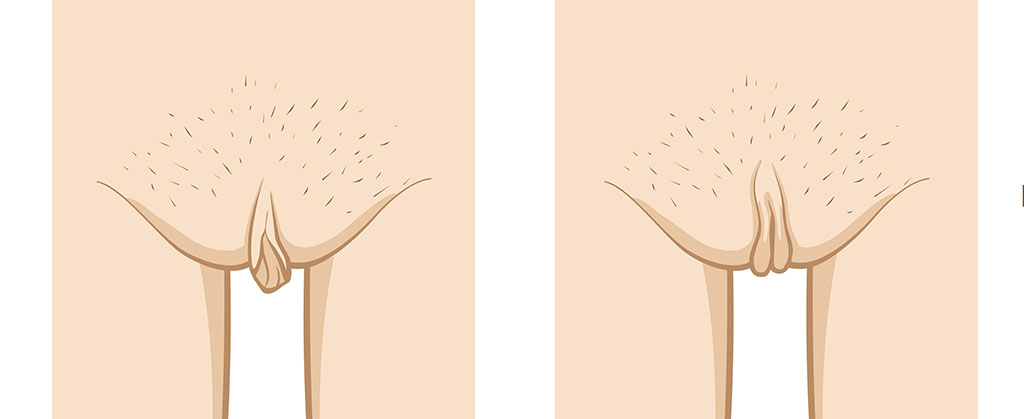 How Common Is Labial Asymmetry