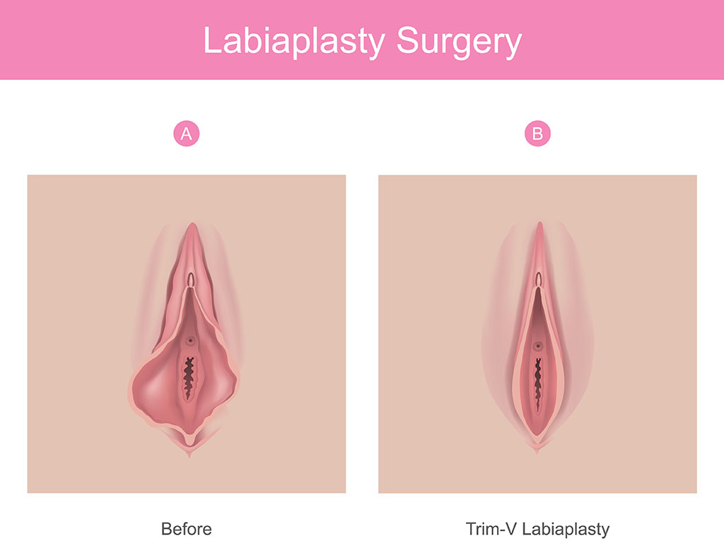 Labiaplasty Surgery