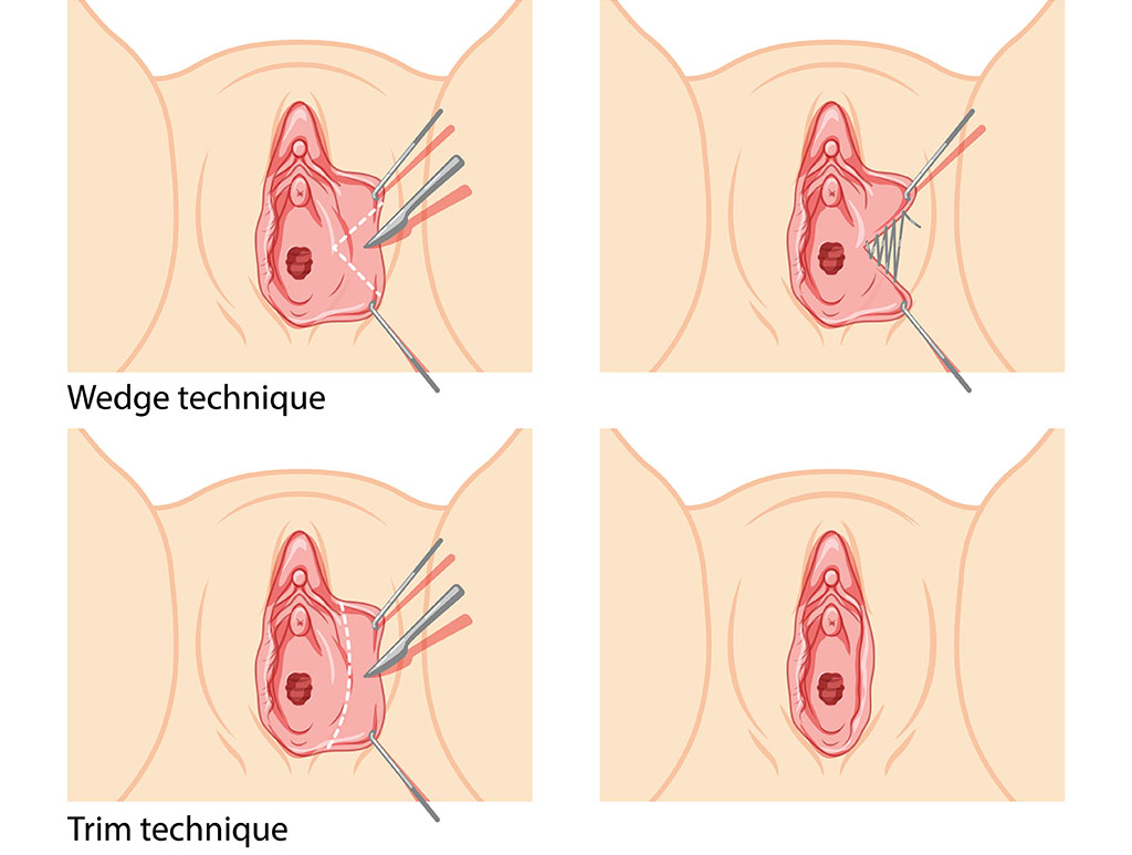 Labial Asymmetry Surgical Option