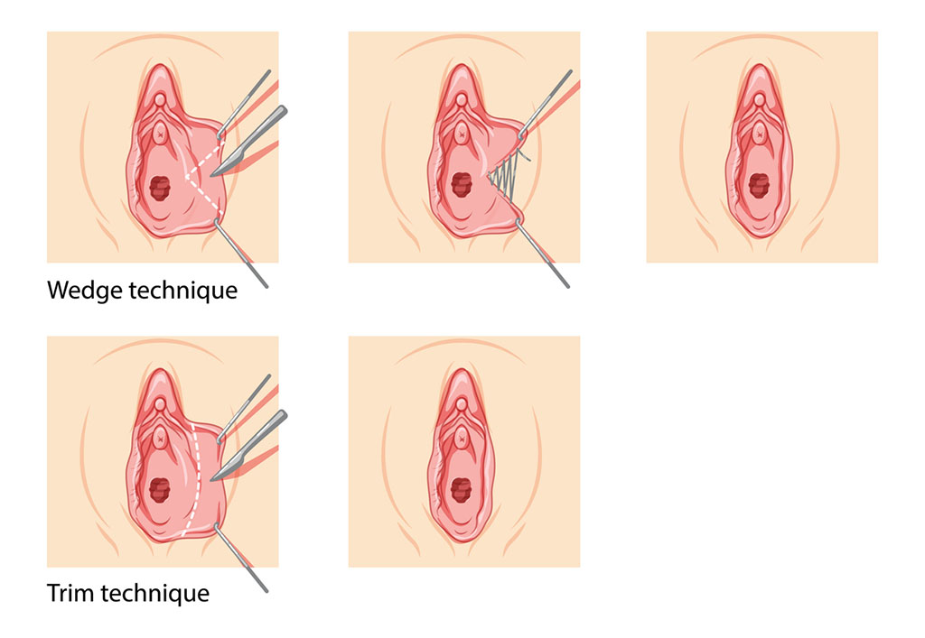 Opción quirúrgica para la hipertrofia labial