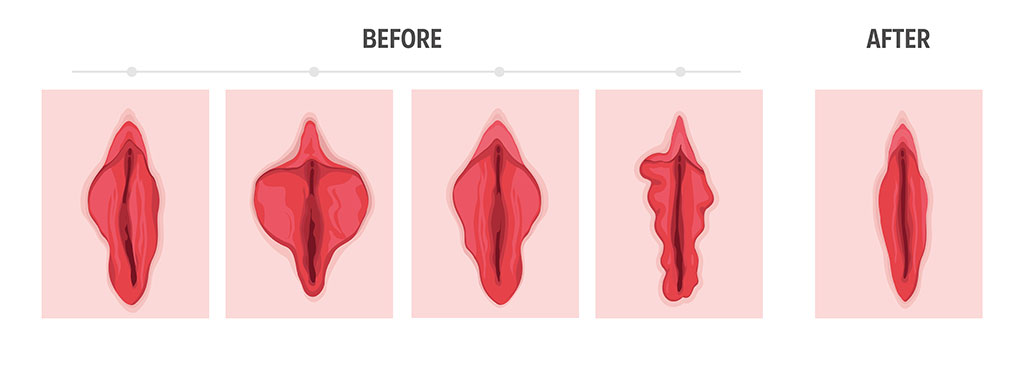 Tipos de labios vaginales