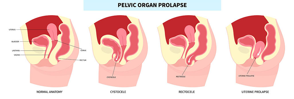 How Pelvic Organ Prolapse Can Cause Vaginal Looseness