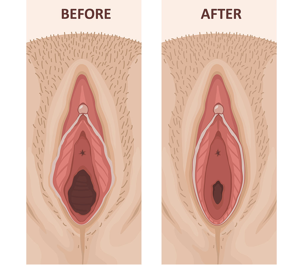 Visión general de los procedimientos de himenoplastia de vagina de diseño y recuperación