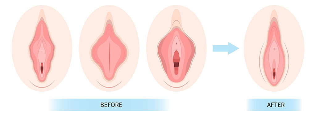 Visión general de los procedimientos y recuperación de la vagina de diseño de la labioplastia