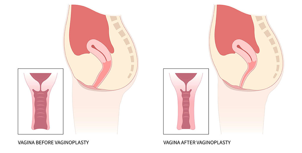 Visión general de la vaginoplastia Procedimientos y recuperación de la vagina de diseño