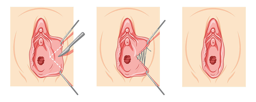 Surgical Methods to Tighten Labia Majora Skin