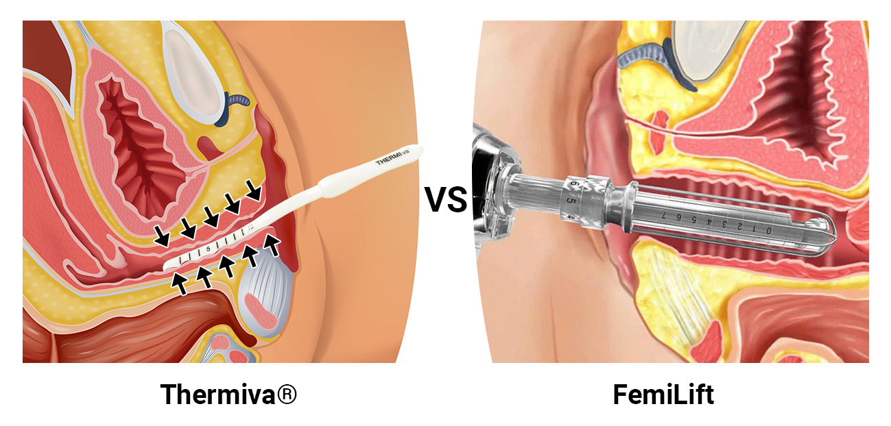 Thermiva® Vs. FemiLift NYC