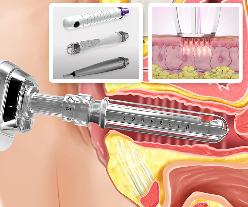 femilift vaginal laser