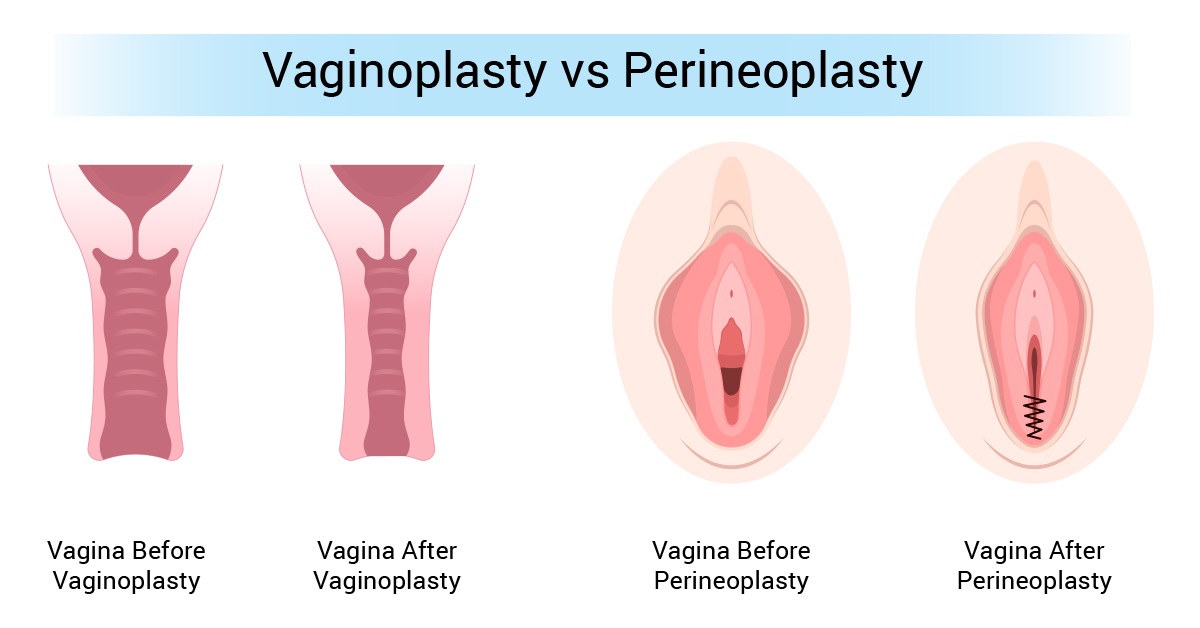 Vaginoplasty vs. Perineoplasty