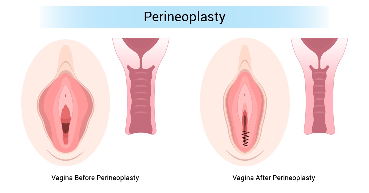 What is Perineoplasty