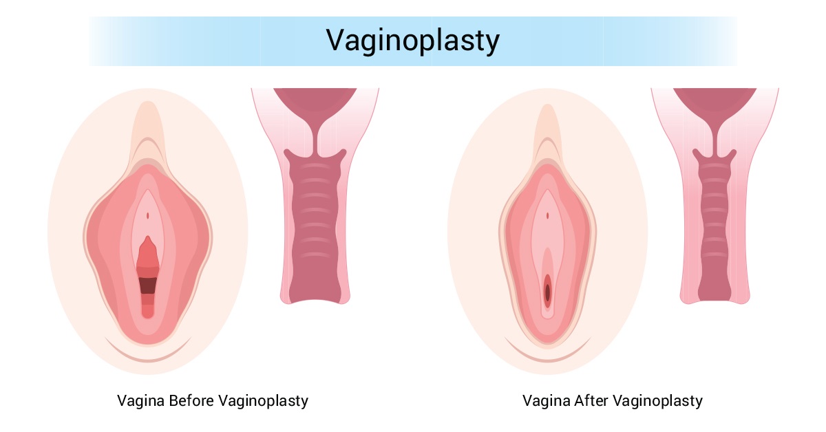 What is Vaginoplasty