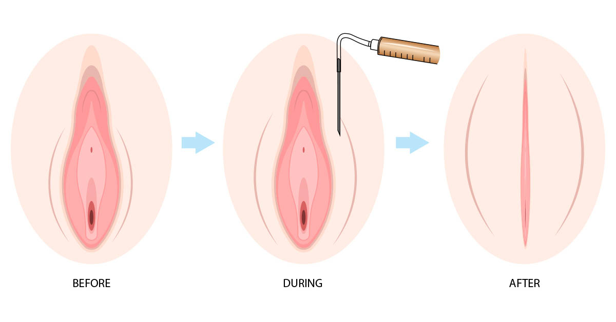 Comparing Vaginal Fat Transfer and Fillers