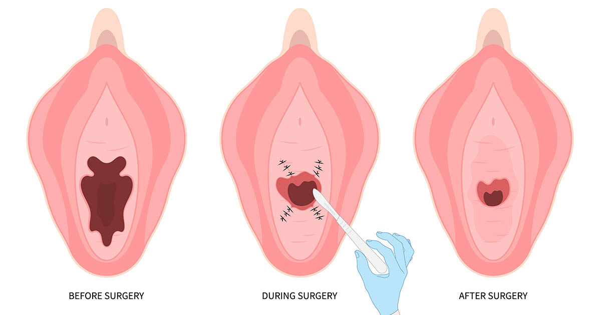 Hymenoplasty