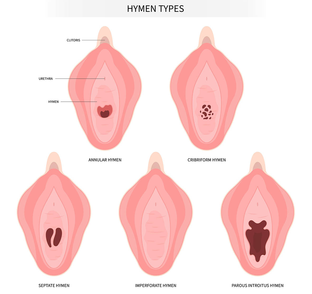 What is Hymenoplasty