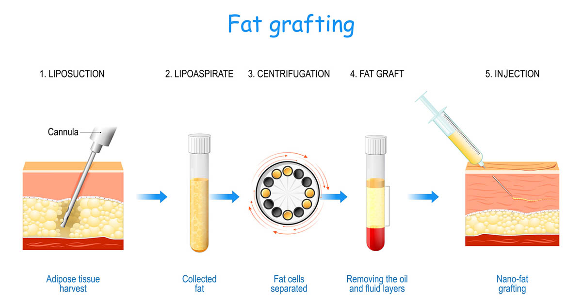 What Is Vaginal Fat Grafting