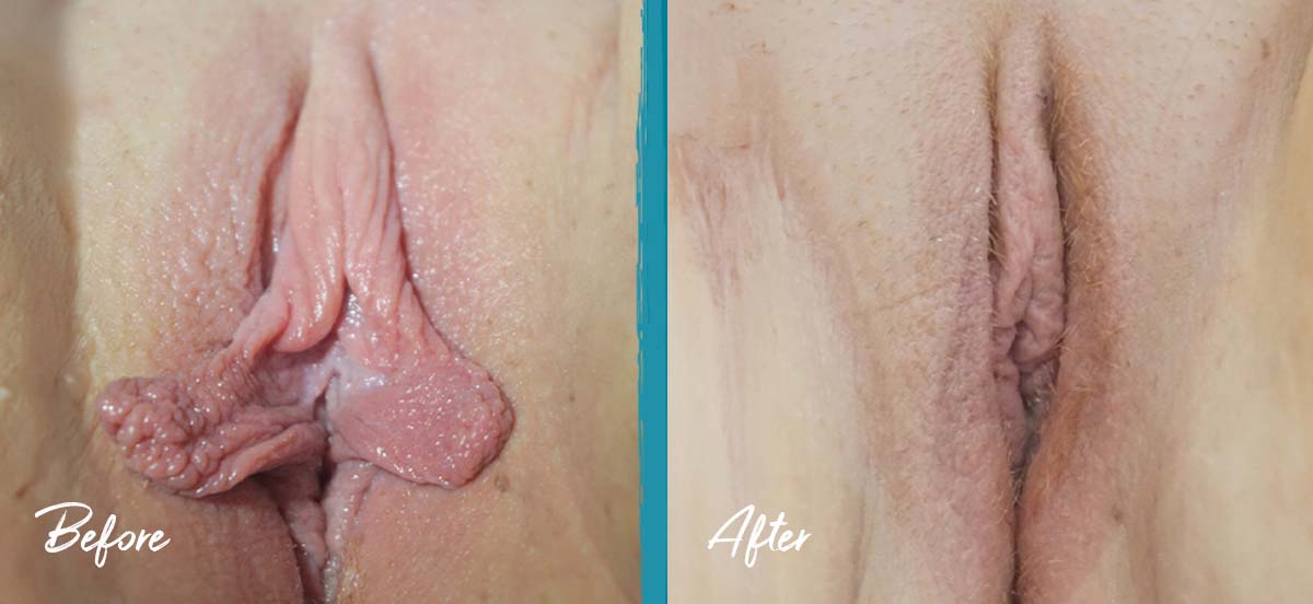 labiaplasty nyc clitoral hood reduction before and after 01