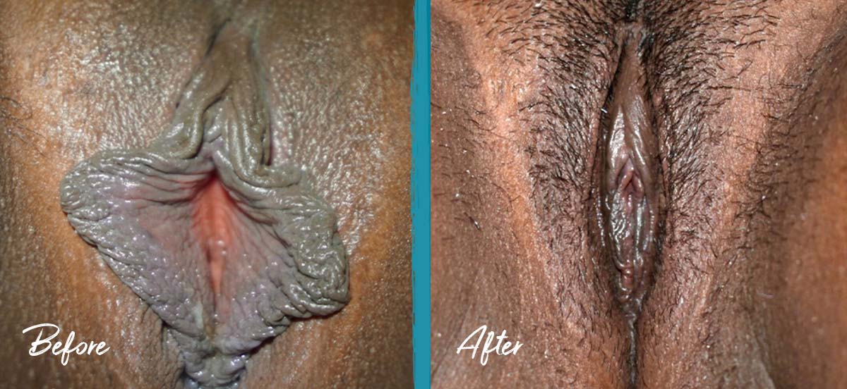 Labiaplasty, Clitoral Hood Reduction & Vulvar Fat Graft NYC Before And After Photo 03
