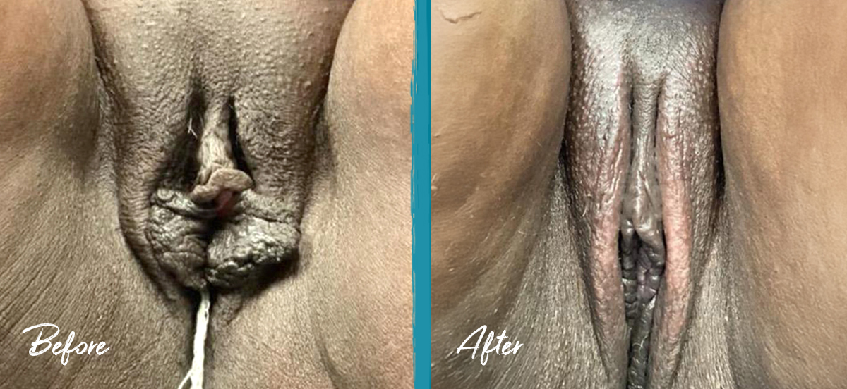 natural and aesthetic appearance of labia