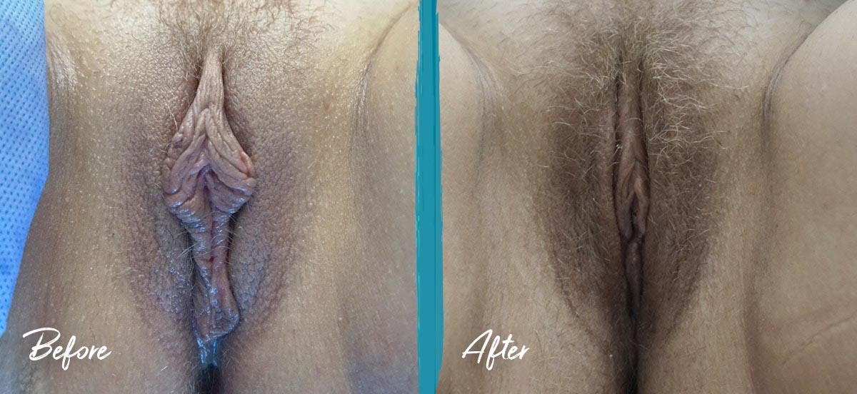 Revision Labiaplasty & Clitoral Hood Reduction NYC Before And After Photo 05