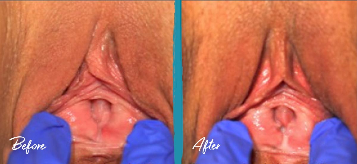 Thermiva Vaginal Rejuvenation Before and After Photo