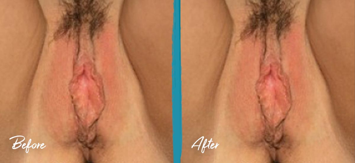 Thermiva Vaginal Rejuvenation Before and After Photo