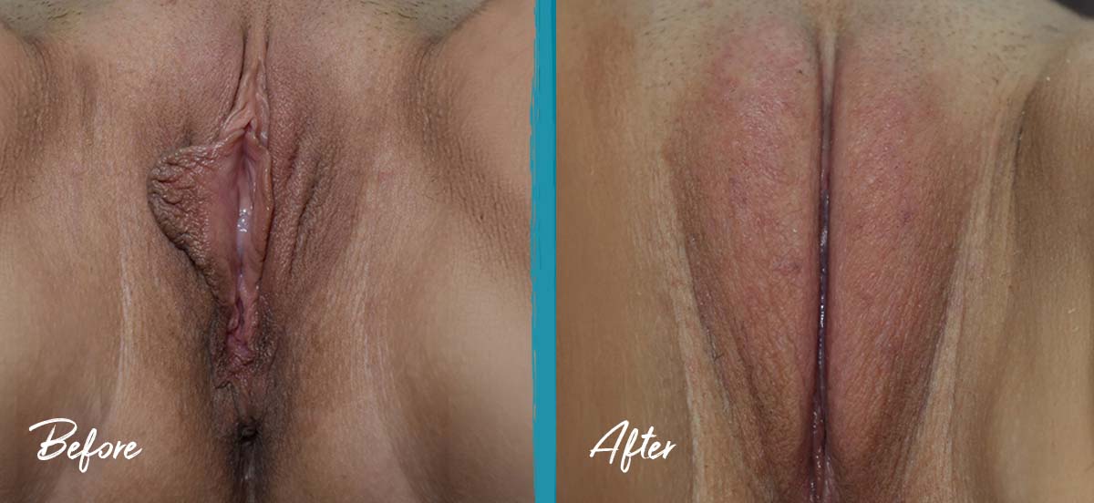 Vaginoplasty, Labiaplasty, Perineoplasty, Clitoral Hood Reduction, Fat Transfer Photo