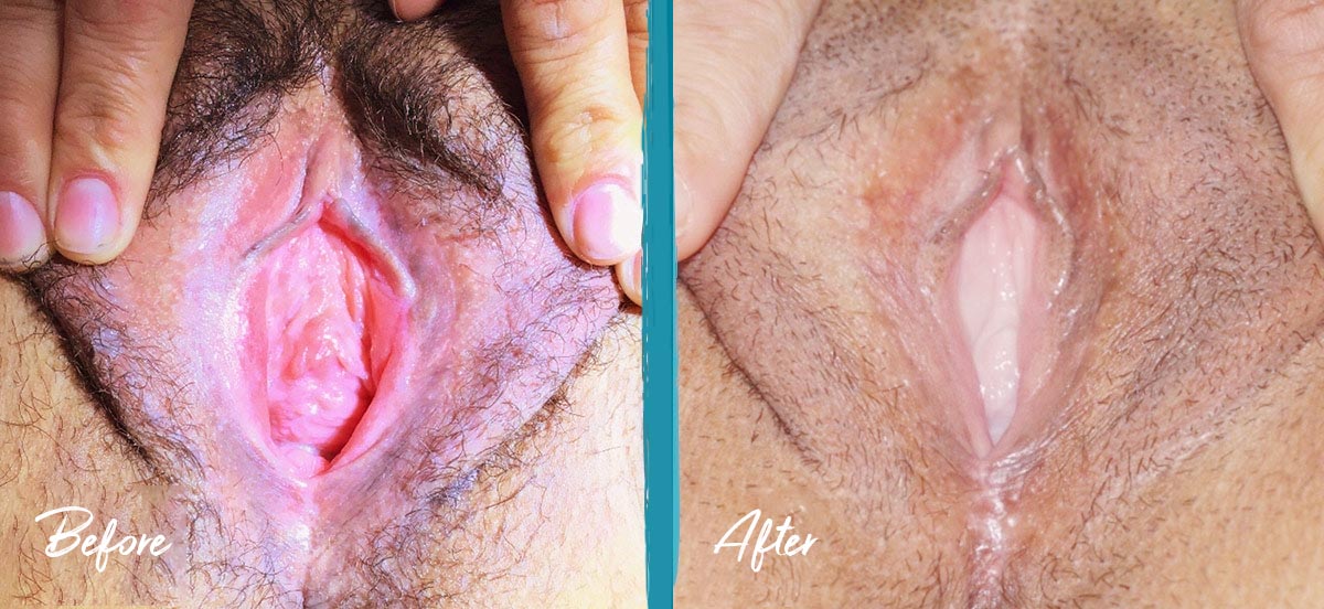 Vaginoplasty & Labiaplasty NYC Before And After Photo