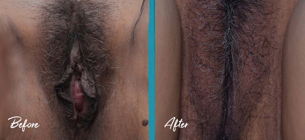 Vaginoplasty, Perineoplasty, Labiaplasty, & Vulvar Fat Graft NYC Before And After Photo