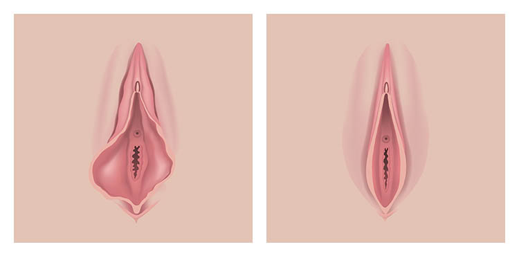 Before and After Labiaplasty Photos