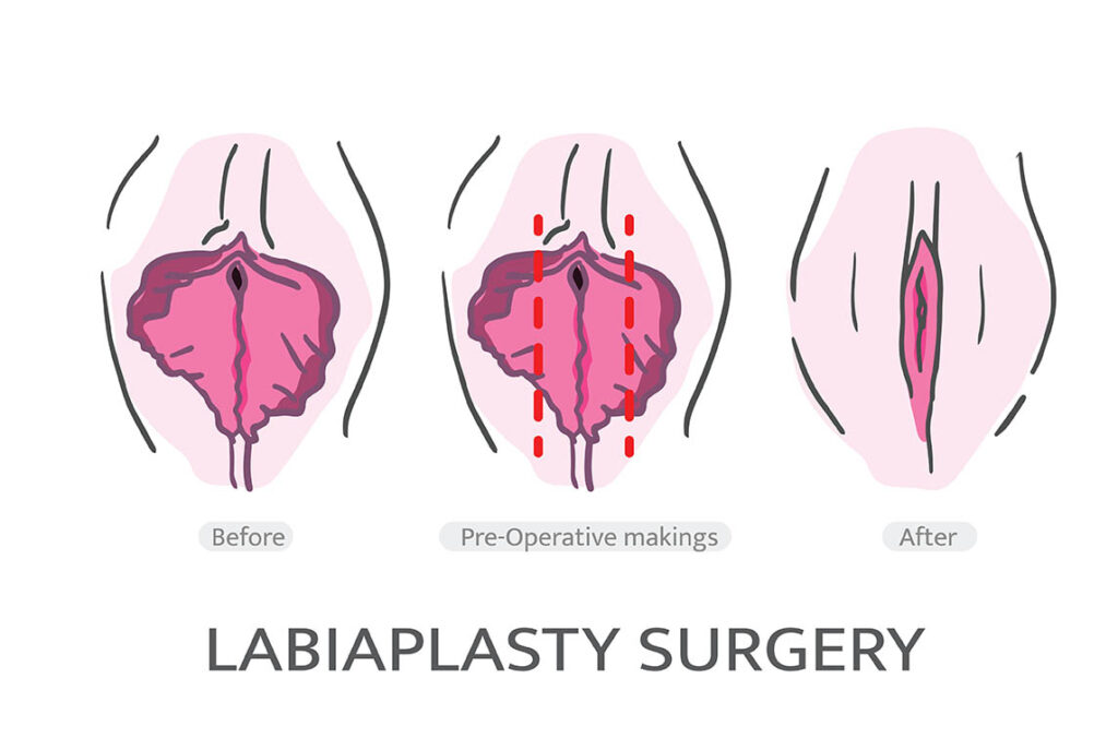 labiaplasty cost details