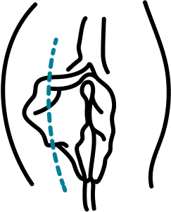 Fat Grafting for Volume Restoration
