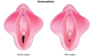 How to Get Virginity Back With Hymenoplasty