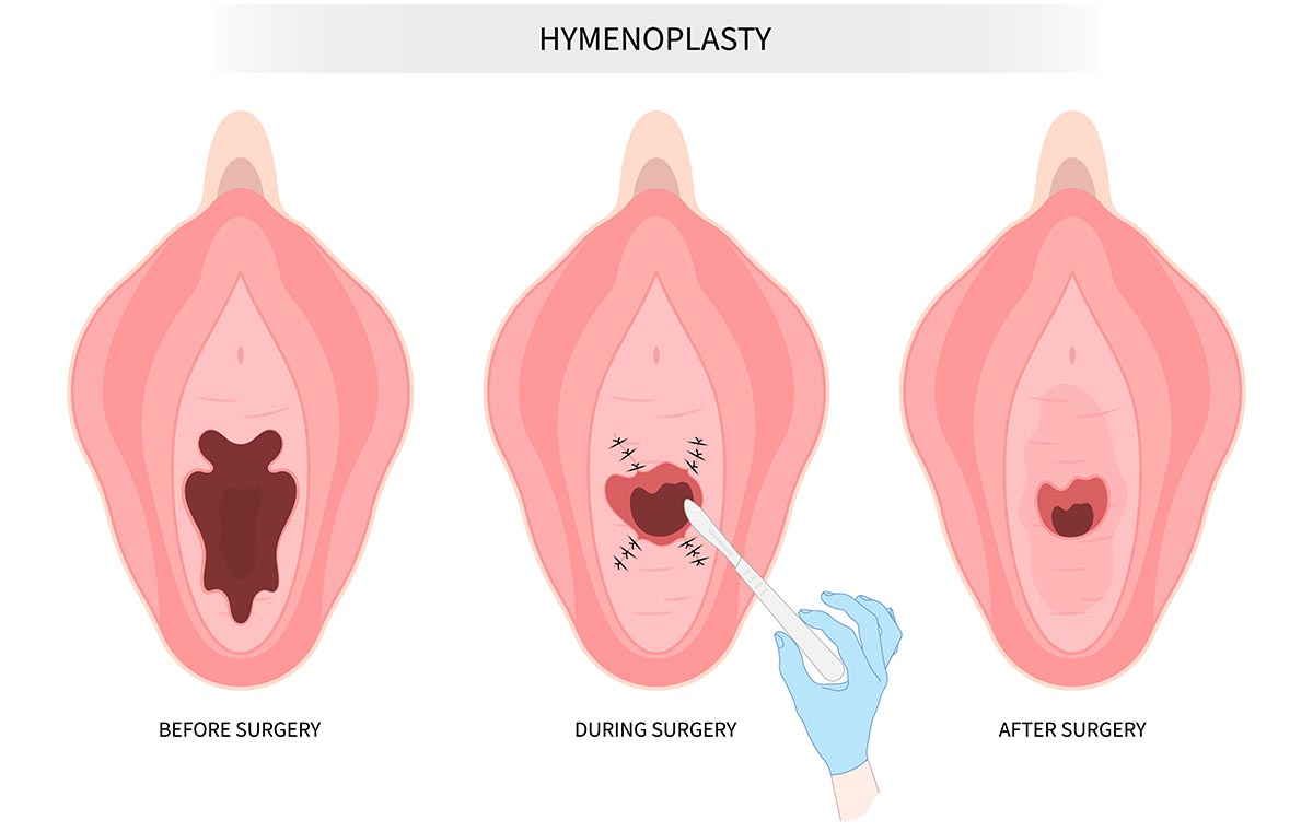 The Hymenoplasty Procedure