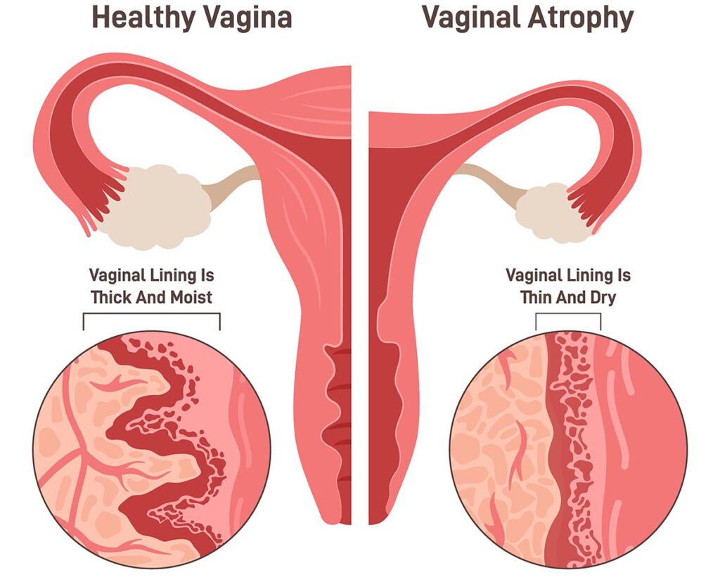 Vaginal Atrophy: Causes, Symptoms, Treatment