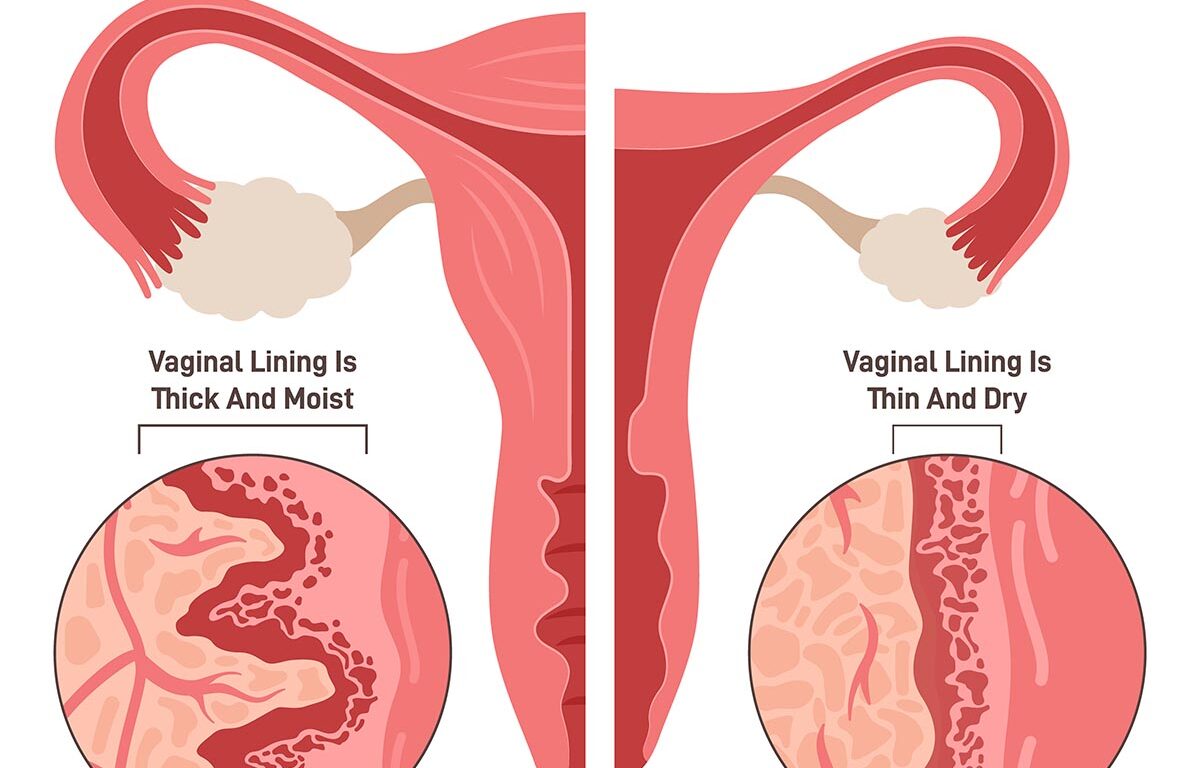 Vaginal Atrophy: Causes, Symptoms, Treatment
