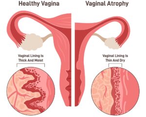 Vaginal Atrophy: Causes, Symptoms, Treatment