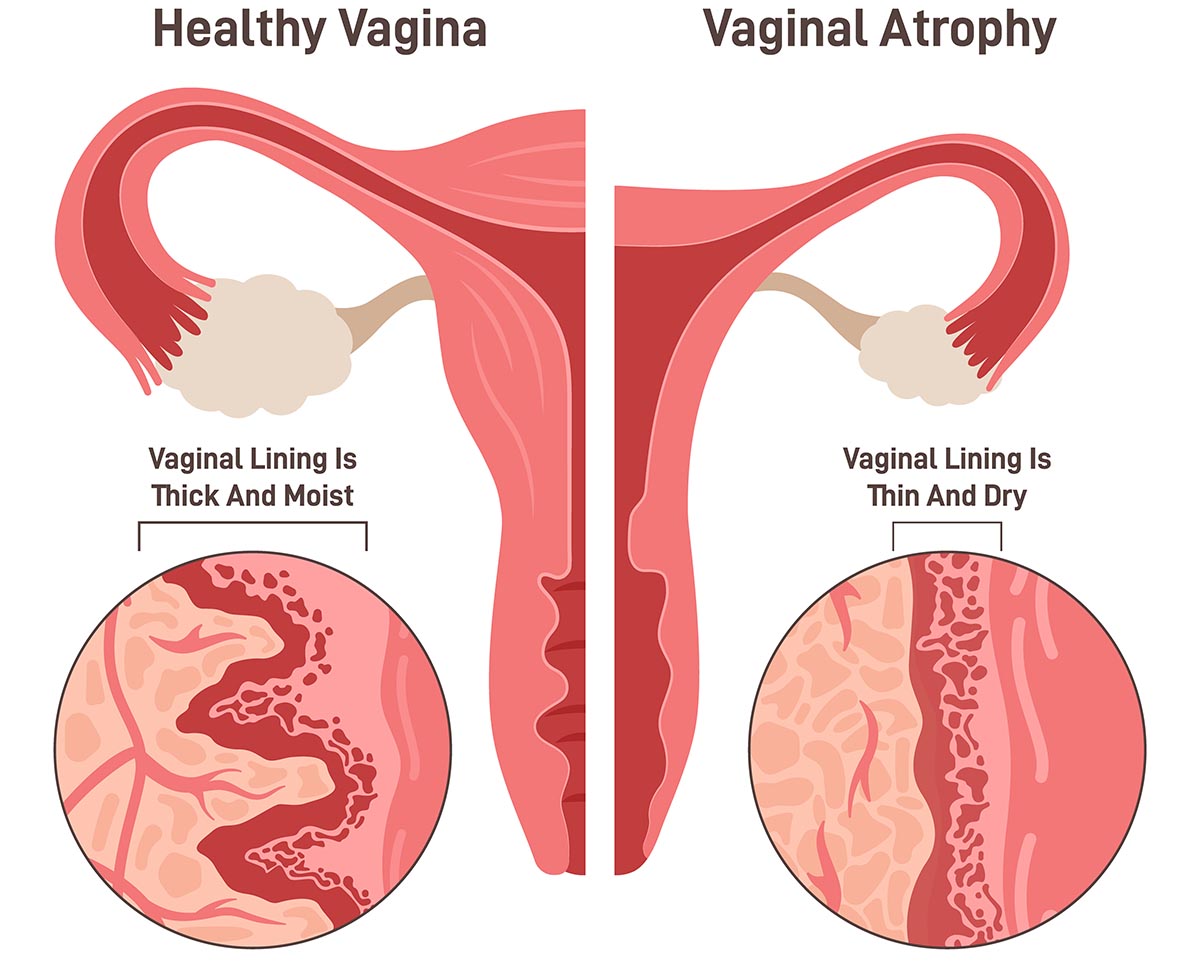 Vaginal Atrophy: Causes, Symptoms, Treatment