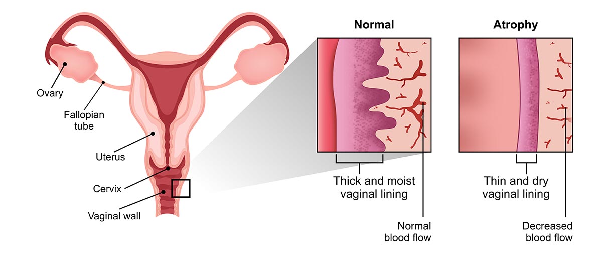 What Causes Vaginal Atrophy?