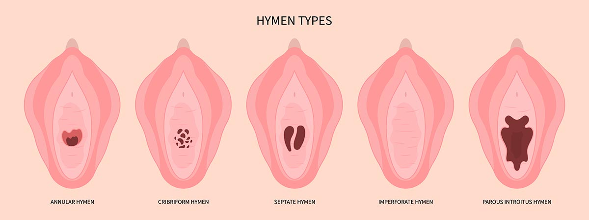 What is Hymenoplasty