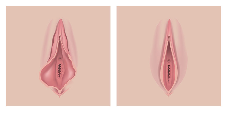 Before and After Labiaplasty Photos in Brentwood