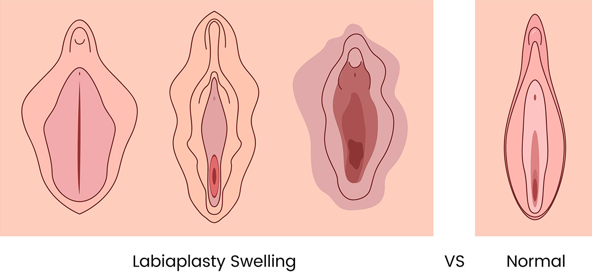 What Normal Labiaplasty Swelling Looks Like