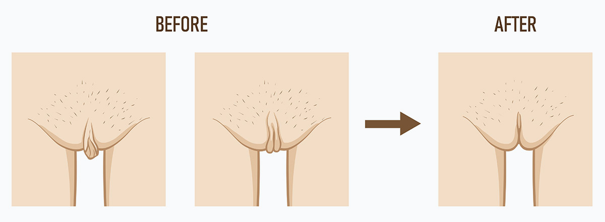 Understanding Labiaplasty From an Anatomical and Clinical Perspective