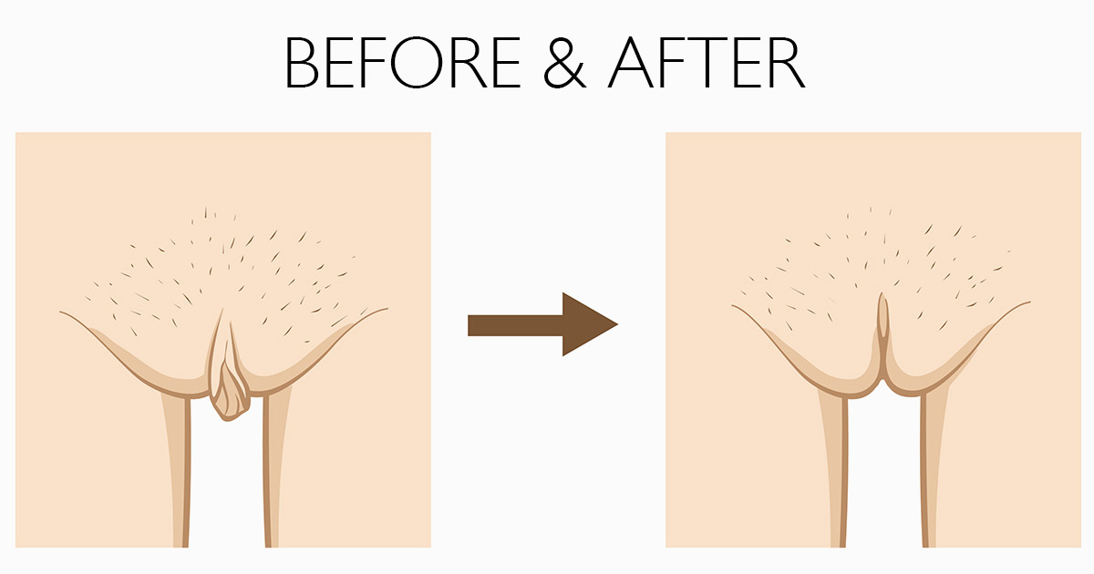 Benefits of Labiaplasty