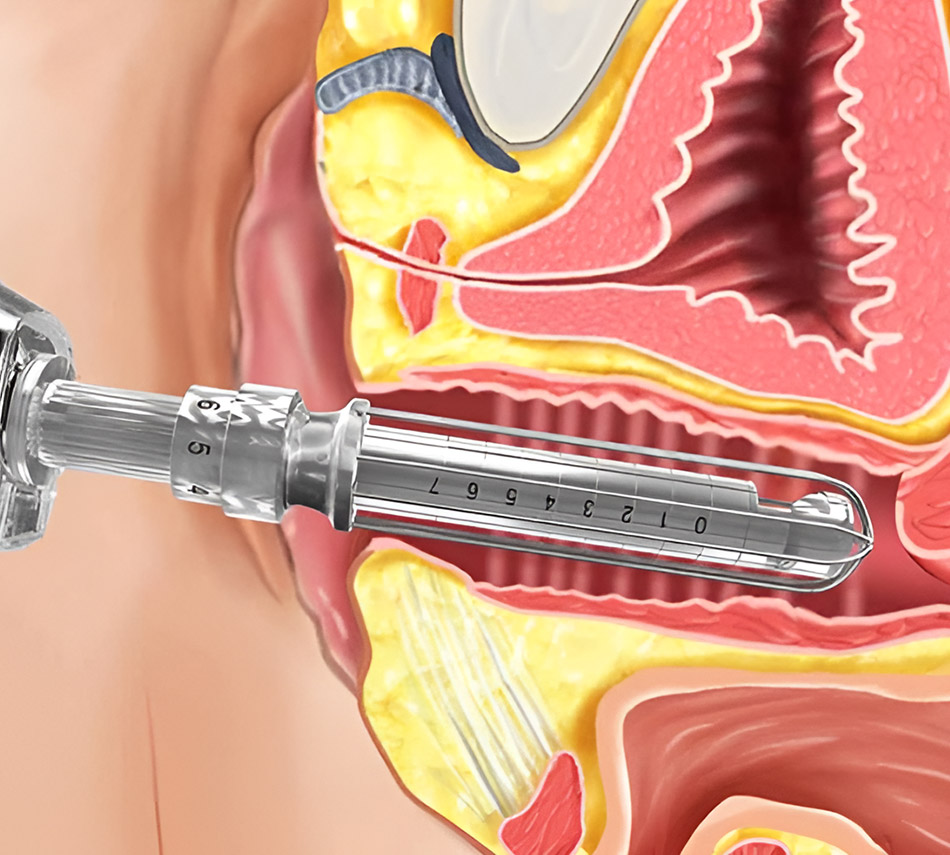 FemiLift CO2 laser near me