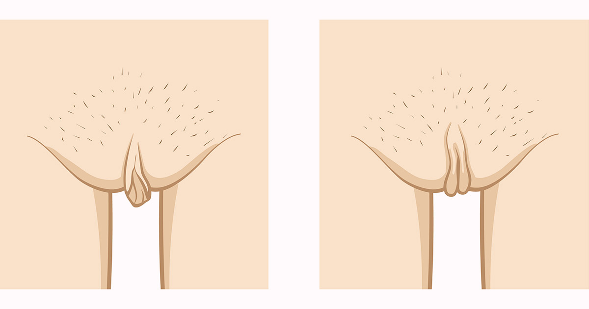 ¿Es frecuente la hipertrofia de los labios mayores?